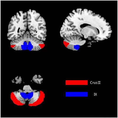 Differences Changes in Cerebellar Functional Connectivity Between Mild Cognitive Impairment and Alzheimer's Disease: A Seed-Based Approach